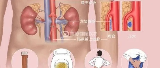 胡桃夹引起的尿蛋白能治好吗